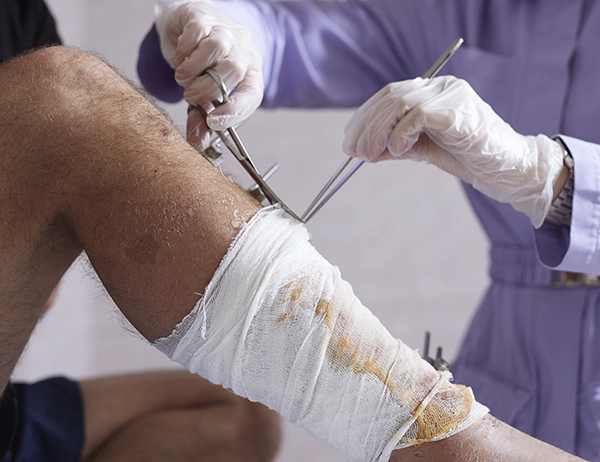 Leg wound being cleaned by mobile wound care nurse